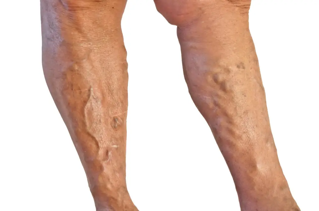 Laserbehandling af åreknuder med endovenøs laser (EVLA) i lokalbedøvelse