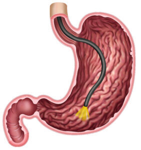 Nasal gastroskopi