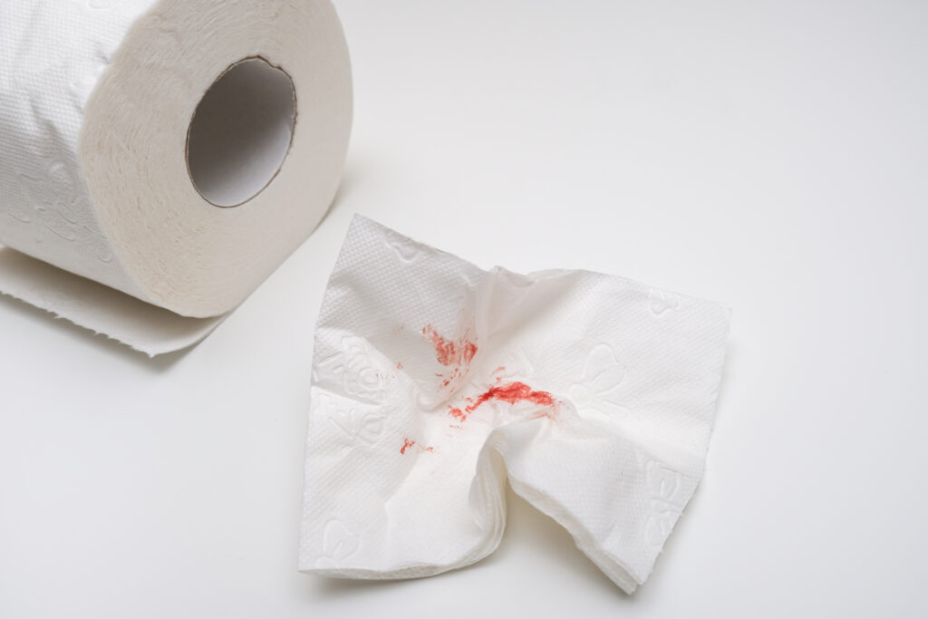 Blod i afføring og på toiletpapir – tegn på blødning fra endetarmen